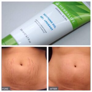 Stretch Marks Combo